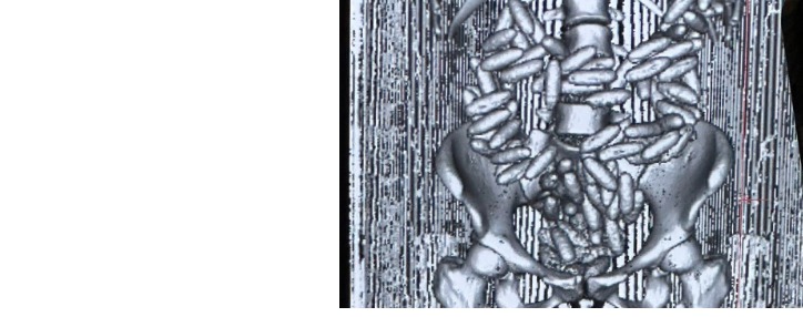 Կոկաինի շուկայական արժեքը գերազանցել է  300 հազ. դոլարը. Բրազիլիայից Հայաստան ժամանած քաղաքացու աղիներում հայտնաբերվել է թմրամիջոցի (ՎԻԴԵՈ)