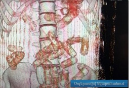 845 գրամ կոկաին՝ որովայնում․ Վիեննայից ժամանած տղամարդու մարմնում 50 պատիճ է հայտնաբերվել (ՎԻԴԵՈ)