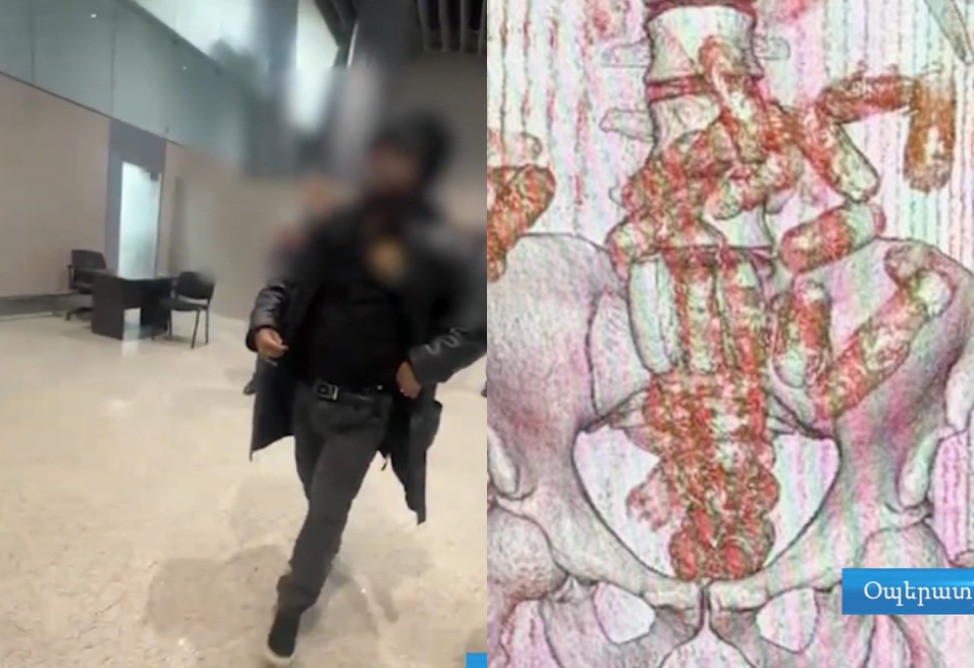 Օդային ճանապարհով քաղաքացին մարմնում Հայաստան է ներմուծել 845 գրամ կոկաին (ՎԻԴԵՈ)